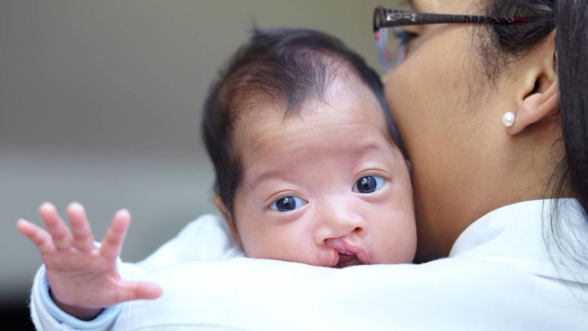 Los médicos especiales llevarán a cabo una cirugía gratuita para niños con labios leporino del 6 al 10 de junio

 – Ojo critico