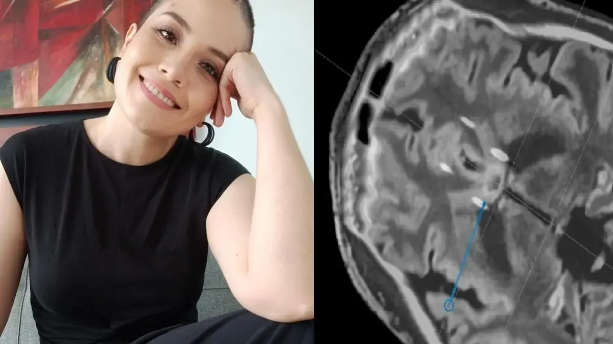 ¿Existe una operación para mejorar la depresión? La historia de una mujer que aprobó el procedimiento cerebral pionero

 – Ojo critico