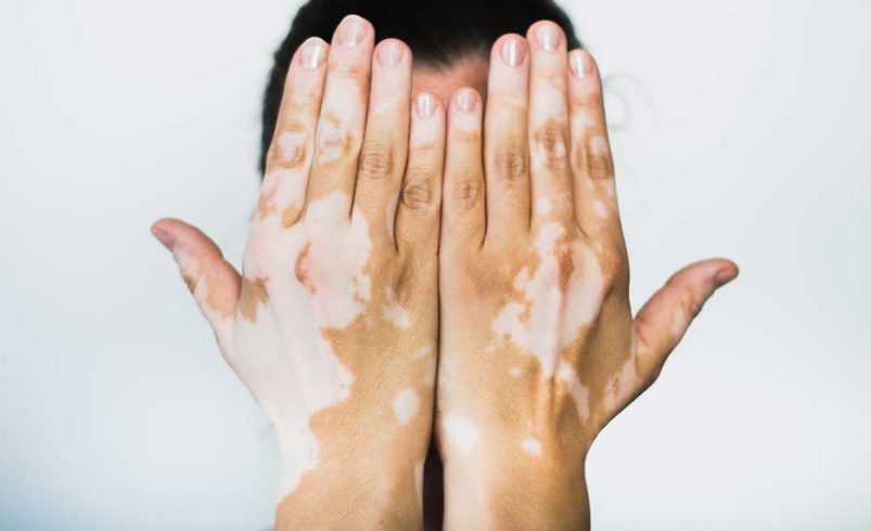 Día del Vitiligo Mundial: una fecha para hacer visible, comprender y seguir

 – Ojo critico