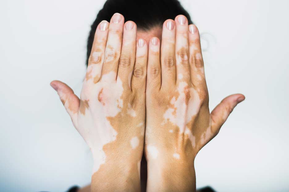 Día del Vitiligo Mundial: una fecha para hacer visible, comprender y seguir

 – Ojo critico