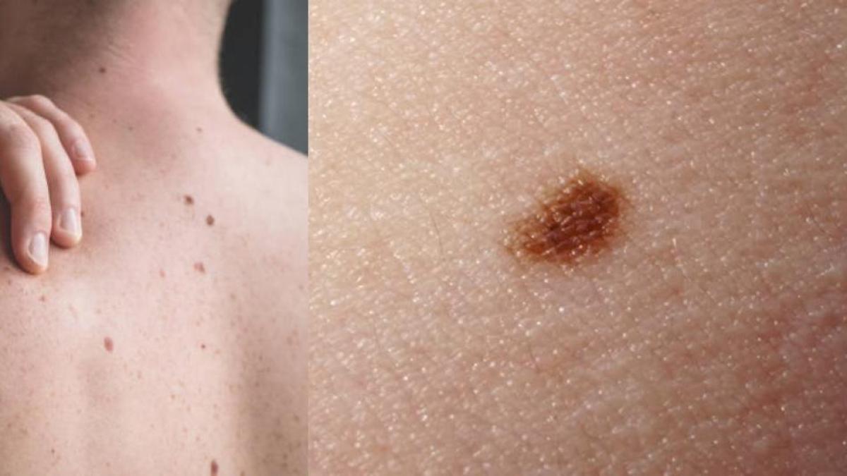 El día libre de verificar la luna está dirigido a prevenir el cáncer de piel

 – Ojo critico