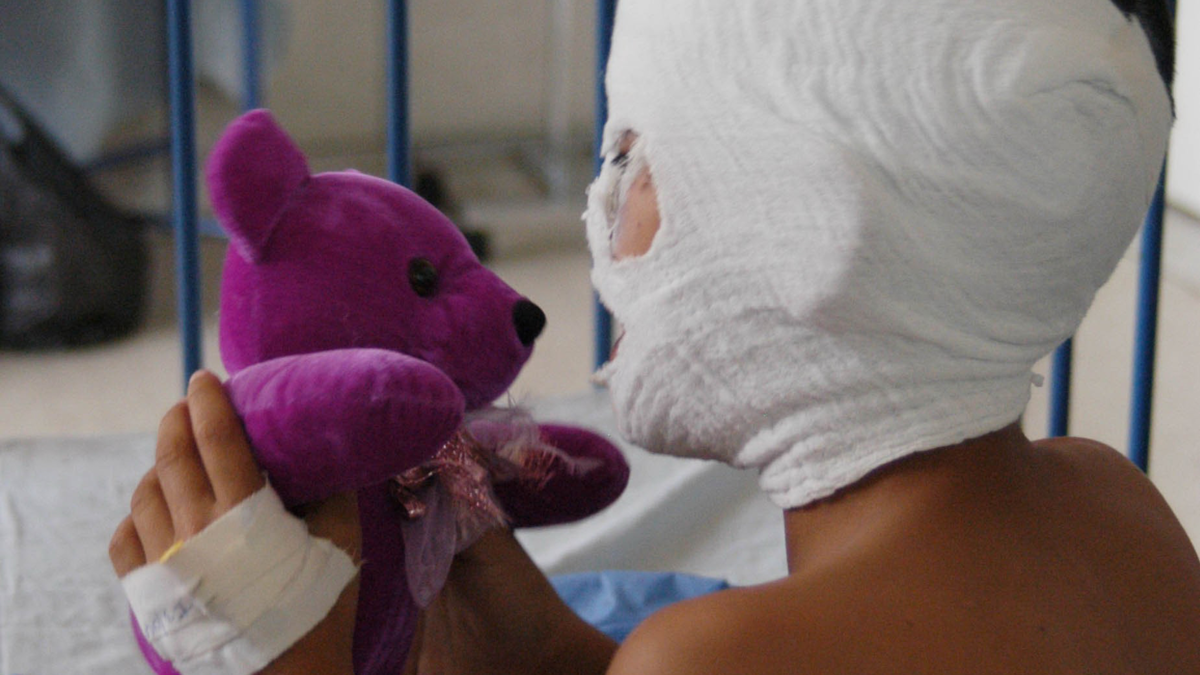 Más de 30 personas sufrieron quemaduras de pólvora en Nariño; Una de las víctimas es un niño de 4 años con heridas faciales y ojos dañados.

 – Ojo critico