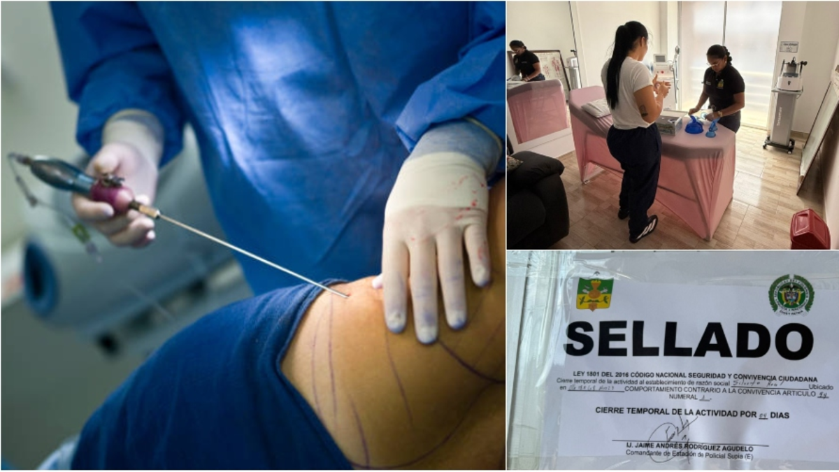 Una liposucción secreta realizada en un balneario de Caldas dejó con mala salud a una joven de 26 años y reveló graves anomalías

 – Ojo critico